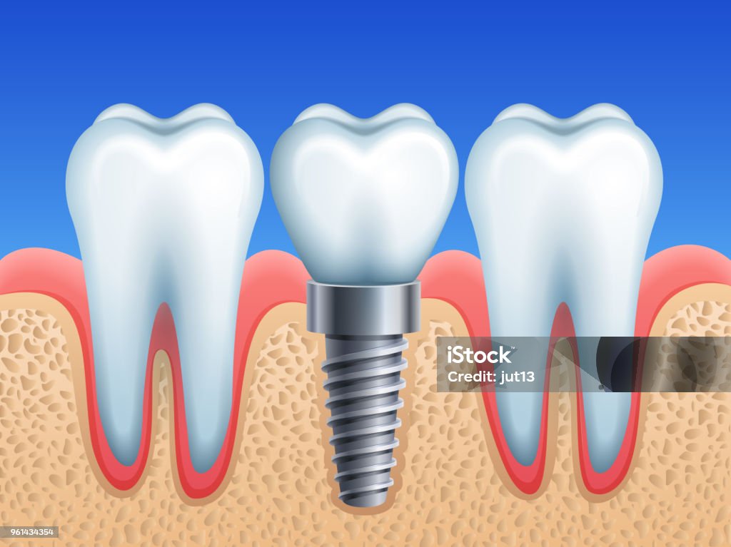 Vector illustration - dental implant and teeth