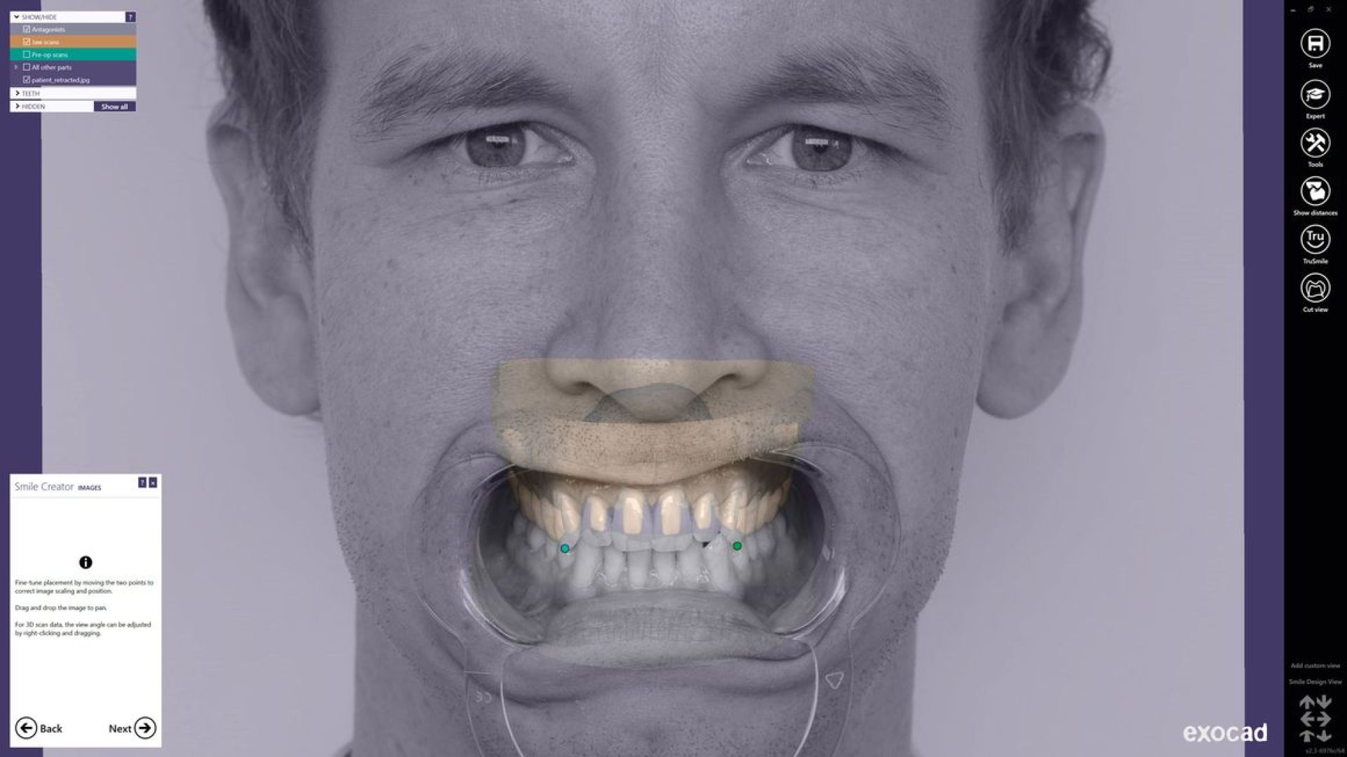 csm_exocad_Smile_Creator_Page_06_Precise_73d642b55d